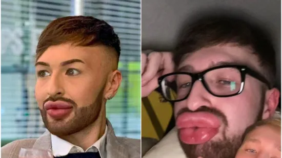 Ovisnost o fileru i botoksu pretvorila ga u patku, a onda je napravio čudo: Sada izgleda kao maneken